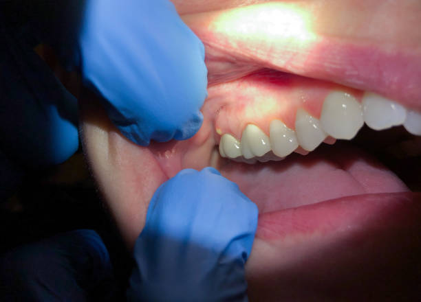 Best Emergency Gum Treatment in Stroudsburg, PA